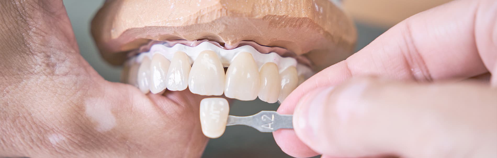 Ik mis een tand of kies